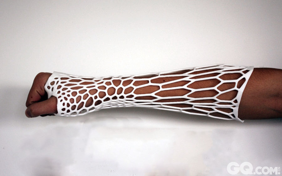 2013年7月3日报道，维多利亚惠灵顿大学毕业的Jake Evill提出了他最新的概念设计“皮质外骨骼”，一种采用3D打印技术的创伤区域固定技术，以取代传统的石膏。

皮质外骨骼采用通风、超轻、时尚和可回收设计，并且使用3D打印技术。受伤骨折的病人会先接受X-射线和三维扫描，其中X光是用来了解病情，确定骨头断裂位置，三维扫描则是用来确定肢体的尺寸。数据得到后，将输入到计算机，在骨折处生成适合的外骨骼3D模型，并直接在患处打印出来，皮质外骨骼是非常薄的，但是却十分结实耐用，用户可以像以往一样穿上长袖长裤，并且可以洗澡。   
