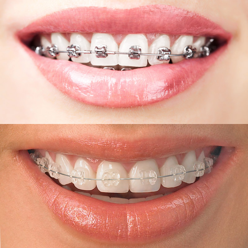 5mm的透明塑料牙套来矫治牙齿.